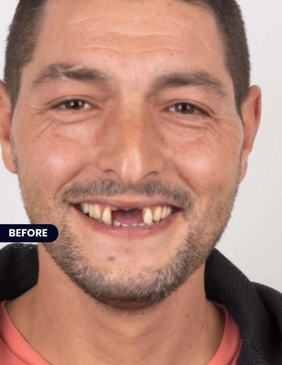 Before: Embarking on Composite Bonding for a Perfect Smile