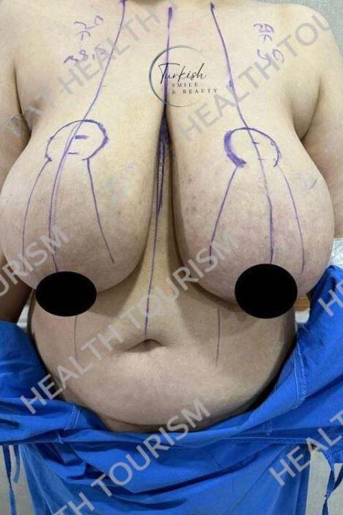 Before Breast Augmentation surgery