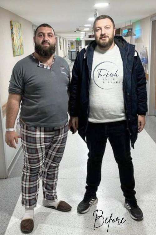 Two Guys Before Thieir Weight loss Treatment