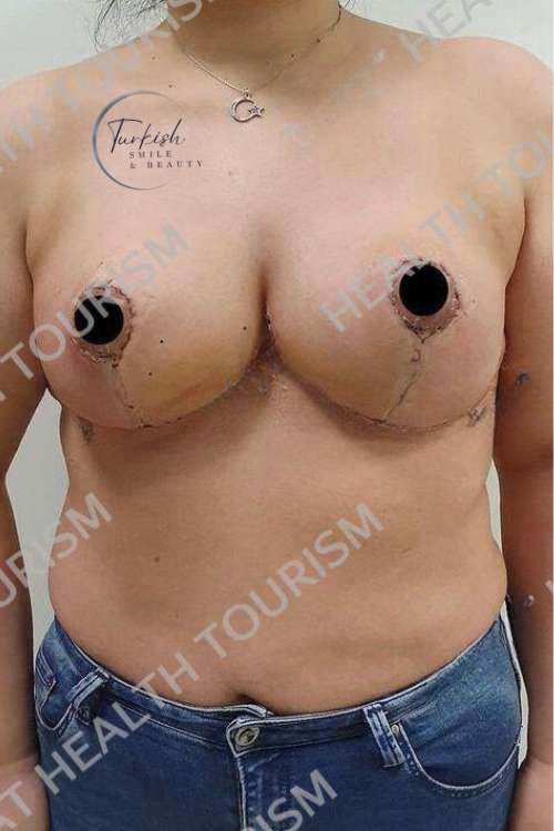 After Breast Augmentation surgery