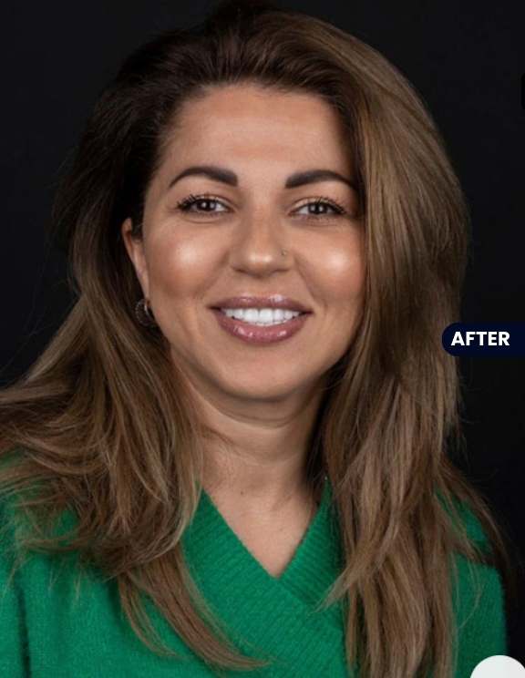 After: Invisalign Success - The Clear Path to Straight Teeth