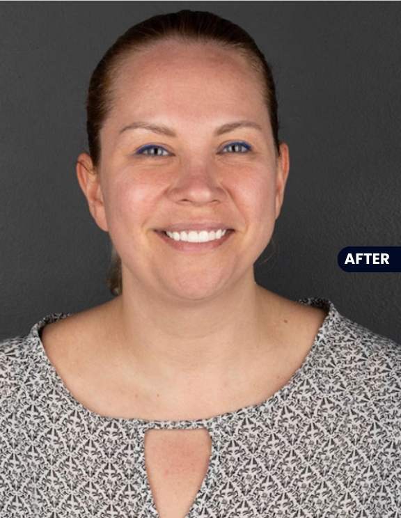 After: Stunning Transformation Achieved with Veneers