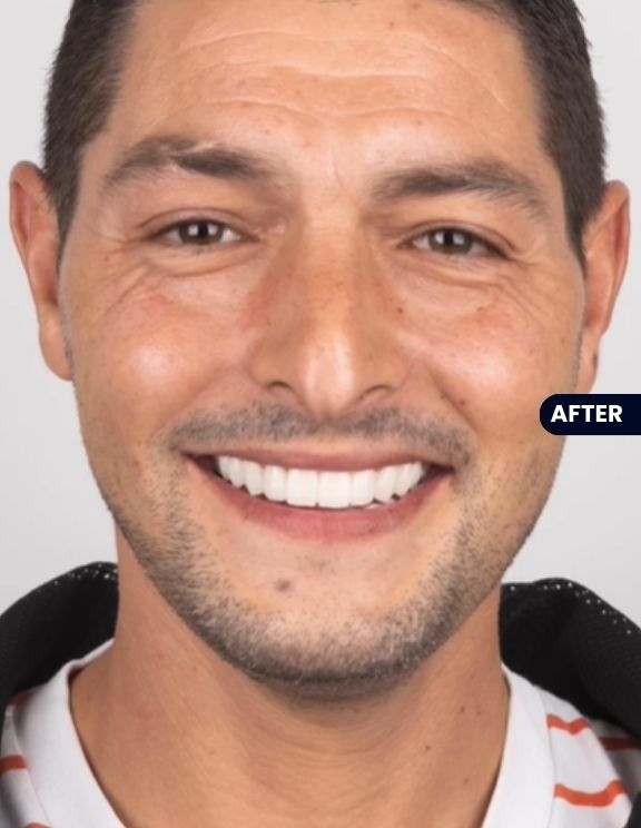 After: Flawless Smile Completed with Composite Bonding