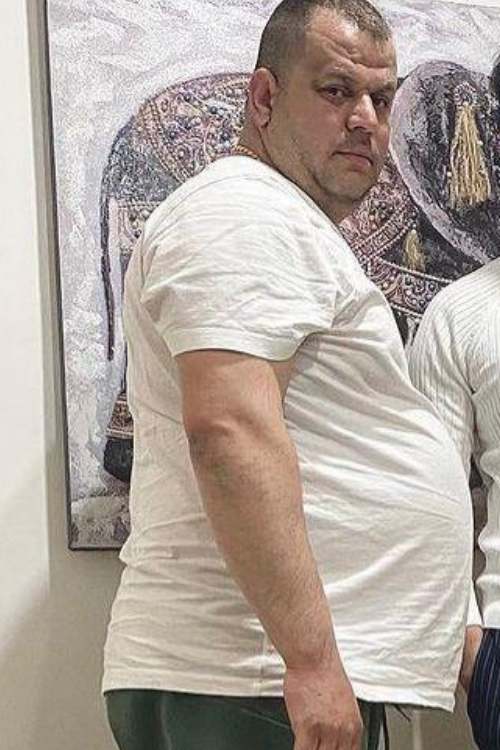 A man Before His weight Loss Treatment in Turkey